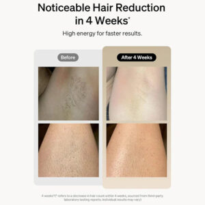 Alternative view of IPL Hair Removal Device for Women & Men